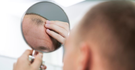 The Early Signs Of Balding And How To Stop It